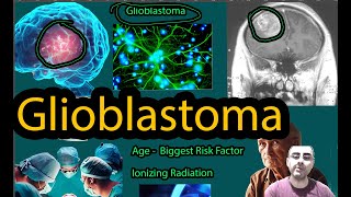 Glioblastoma  Symptoms causes and new hope [upl. by Wyck317]