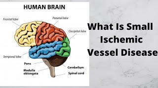 What Is Small Ischemic Vessel Disease [upl. by Paulita]