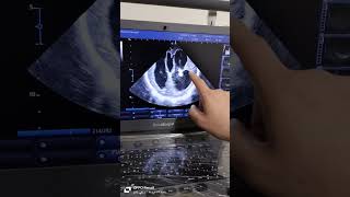 Cranial Ultrasound ē marked hydrocephalus [upl. by Tager]