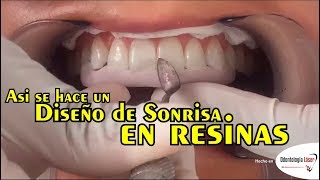 Asi se hace un Diseño de Sonrisa en resinas  Odontología Láser DiseñoDeSonrisa [upl. by Meadow]