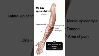 quotKnow the pain Medial epicondylitis also known as golfers elbow effects the inner elbowphysio [upl. by Vanessa739]