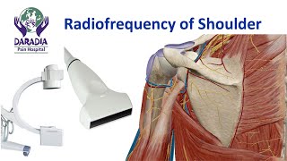 Shoulder Joint Radiofrequency Procedure  Cooled RF of shulder [upl. by Adihsar]