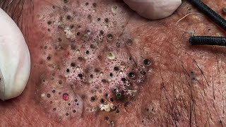 Big Cystic Acne Blackheads Extraction Blackheads amp Milia Whiteheads Removal Pimple Popping  621 [upl. by Felton730]