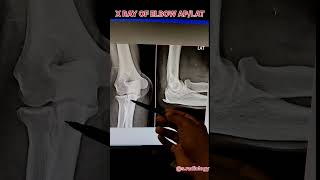 X Ray of Elbow joint osteophytes [upl. by Negyam]