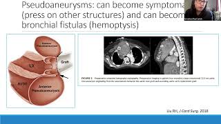 Aneurysms Outside the Aortic Root [upl. by Rialb]