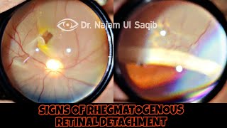 Clinical Signs Of Rhegmatogenous Retinal Detachment [upl. by Ilahsiav]