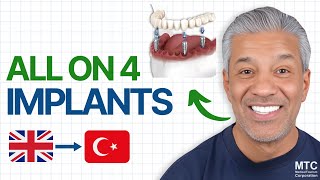 All on 4 Dental Implants in Antalya Did this UK Citizen Take the Right Decision [upl. by Ellerahs603]