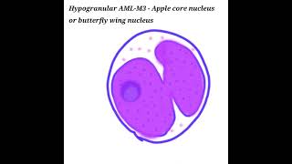 Difference between microgranular and hypergranular variant of AMLM3 APML  Pathology for all [upl. by Adnalram]