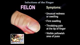 Infections Of The Finger  Everything You Need To Know  Dr Nabil Ebraheim [upl. by Jarad]