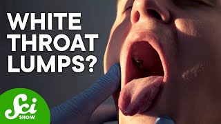 What Are Tonsil Stones amp How Do I Get Rid of Them [upl. by Aiekram323]