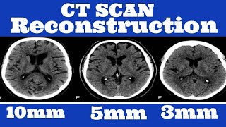 How to Do Ct Reconstruction [upl. by Panchito]