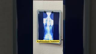 Kyphoscoliosis treatment by DrRavi scoliosistreatment kyphosis spine chiro short reeltrending [upl. by Ynohtn]