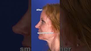 Revision Rhinoplasty Case rhinoplastyrevision revisionsurgery facialplasticsurgery [upl. by Scherman]