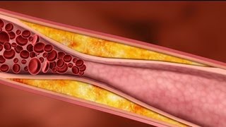 Cholesterol What are Plaques [upl. by Sofer]