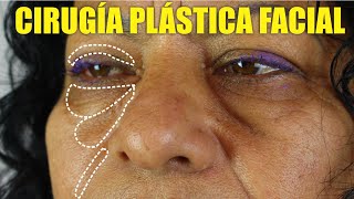 BOLSAS de los OJOS y PÁRPADOS CAÍDOS 🙈 RESULTADOS de una BLEFARIPLASTÍA Doble ⭐ DR PERCY NEVADO [upl. by Medin]