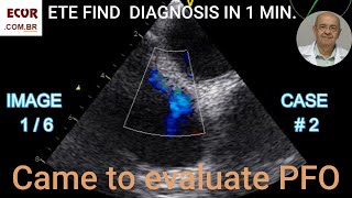 The Secret Differences Between PFO ASD Vena Cava and CSV [upl. by Arhoz]