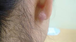 Ear Piercing amp Keloid [upl. by Ajit]