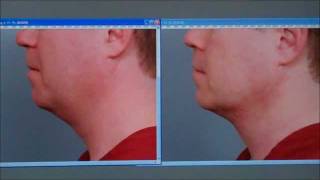 Smartlipo of the Neck  Case Study  Dr Sterry [upl. by Morganstein]