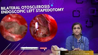 BILATERAL OTOSCLEROSIS ENDOSCOPIC LEFT STAPEDOTOMY  DRSHAKUNTALA GHOSH  SRI RAMA ENT CARE CENTER [upl. by Aohk]