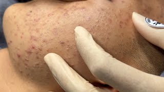 ACNE TREATMENT BO NGUYỄN  Perennial Blackheads On Boy 2024 [upl. by Ranzini969]