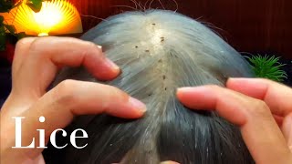 ASMR Scalp Scratching Lice Removal 🥱😴💤 [upl. by Pisarik]