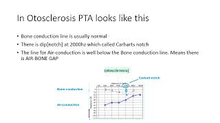 Otosclerosis 4th year [upl. by Alekat]