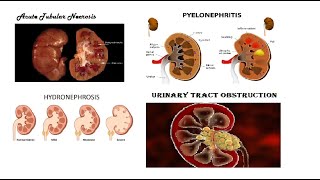 Pathology Urogenital  Tubular Disease amp Pyelonephritis amp Hydronephrosis amp Urinary Tract Obstruction [upl. by Aekin669]