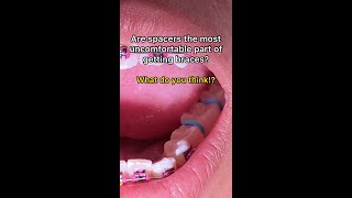 What Are Orthodontic Separators Spacers Tooth Time Family Dentistry New Braunfels Texas [upl. by Haran]