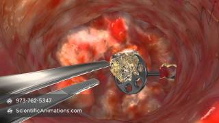 Medical Animation of CO2 Laser Surgery [upl. by Jacobsen318]