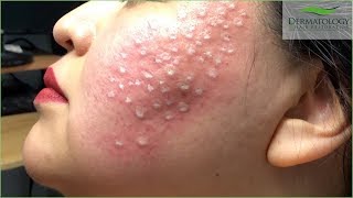 Acne Scar Treatment TCA Cross using TCA 80 [upl. by Asa]