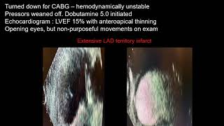 Kapur Novel Approach to Single Arterial Access PCI with VA ECMO in Cardiogenic ShockCoronary [upl. by Dygall]