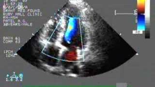 heart color doppler test [upl. by Aeirdna45]