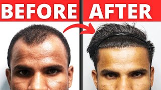 8 Months Hair Transplant Result [upl. by Miahc]