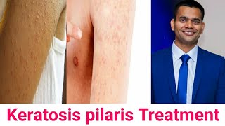 Keratosis Pilaris Cause Symptoms Ayurvedic Treatment [upl. by Elrahc]