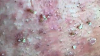 How To Remove Blackheads And Whiteheads On Face Easy 78 ✦ Dr Laelia ✦ [upl. by Essirehs]