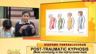 Pagkakaiba ng Kyphosis at Scoliosis  Usapang Pangkalusugan [upl. by Luelle]