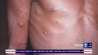 Monkeypox Update with DrBrian Pien Pt2 [upl. by Assiral]