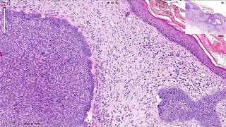 Basal Cell Carcinoma Including Variants  Histopathology [upl. by Harim593]