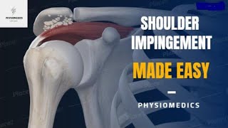 Shoulder Impingement Syndrome  Shoulder Acromion Pain  Shoulder Impingement Exercises [upl. by Kan]