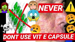 💚VIT E CAPSULE💚  ⚠️ never ⚠️  why you should never use the capsules [upl. by Lenzi]