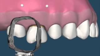 Molar intrusión con implantes  Ortodoncia [upl. by Aneg]