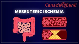 Mesenteric Ischemia [upl. by Lief]