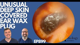 UNUSUAL DEEP SKIN COVERED EAR WAX PLUG  EP899 [upl. by Quin801]