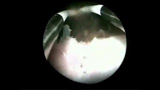 Hysteroscopic drainage of myometrial cystic adenomyosis [upl. by Zanlog]