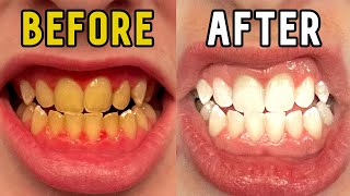 How I Whitened My Teeth in 14 Days [upl. by Teraj805]