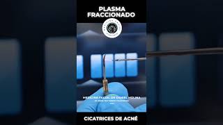 Plasmage para cicatrices de acné acnescars cicatrizdeacne cicatrizacion pielperfecta [upl. by Stolzer]