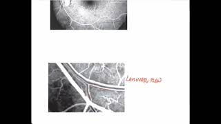 Normal Fluorescein AngiogramOphthalmology [upl. by Andel757]