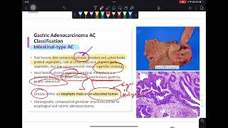 Gastric pathology  Gastric polyps and tumors [upl. by Arikal]