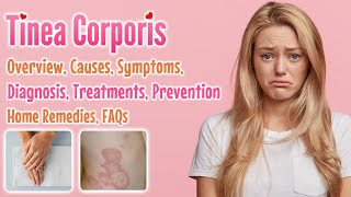 Tinea corporis overview causes sign and symptoms diagnosis treatment home remedies and FAQs [upl. by Datha819]