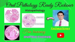 Infections of Oral Cavity Actinomycosis Herpes Tuberculosis Candidiasis Sinusitis [upl. by Larry]